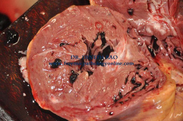 ischemic endocardium